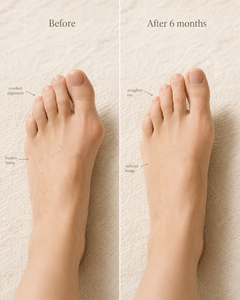 Bunion Correction Toe Corrector Multi-angle Knob Adjustable Male and Female Toe Split Toe Corrector